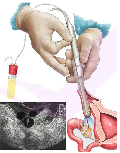 武汉专业的代生机构是什么 武汉人民医院试管技术的好理由 ‘b超单囊胚看男女