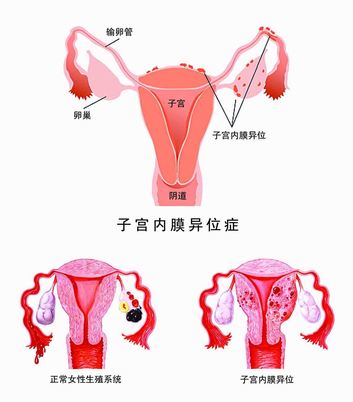 少精弱精可以做试管吗&绝经后怀孕&疼痛、包块和不孕-子宫内膜异位症，你了解